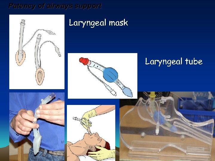 Patency of airways support Laryngeal mask Laryngeal tube 
