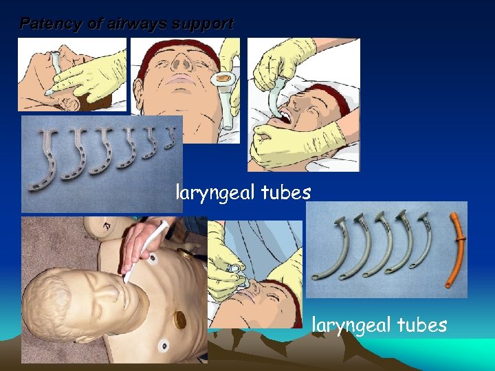 Patency of airways support laryngeal tubes 