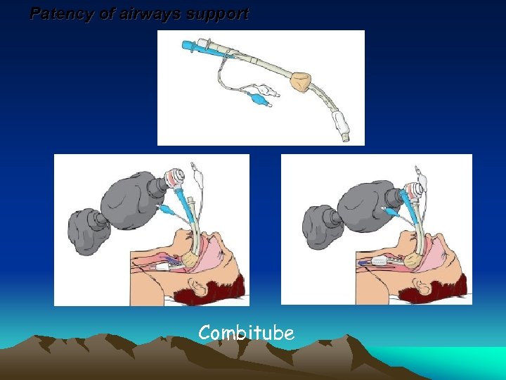 Patency of airways support Combitube 