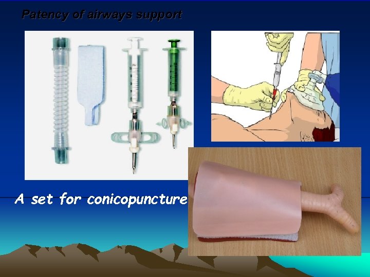 Patency of airways support A set for conicopuncture 