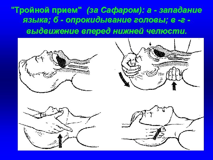 "Тройной прием" (за Сафаром): а - западание языка; б - опрокидывание головы; в -г