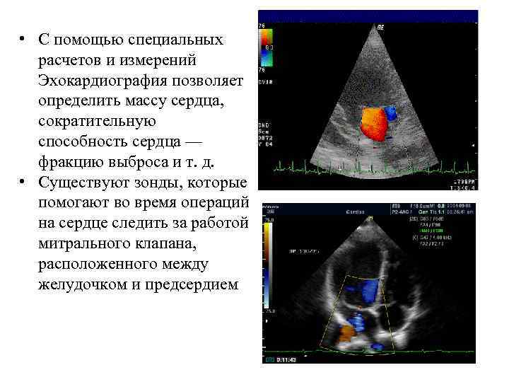  • С помощью специальных расчетов и измерений Эхокардиография позволяет определить массу сердца, сократительную