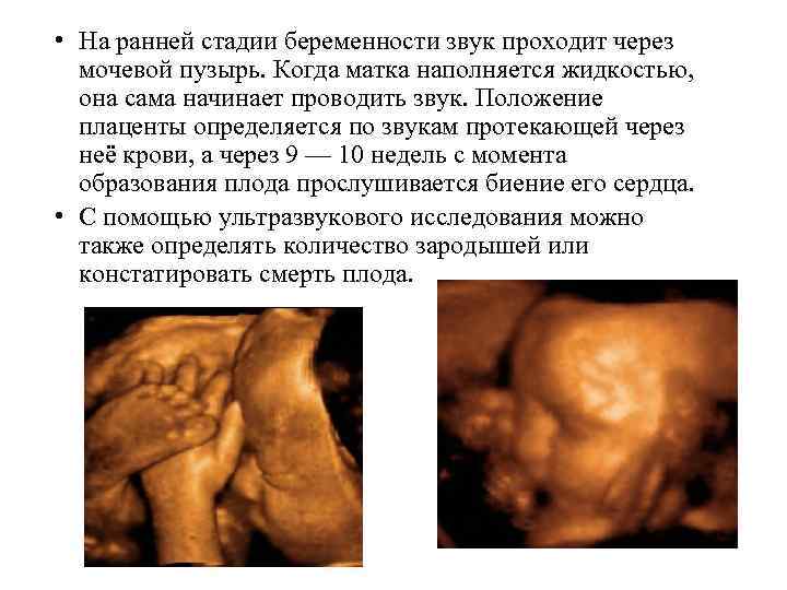  • На ранней стадии беременности звук проходит через мочевой пузырь. Когда матка наполняется