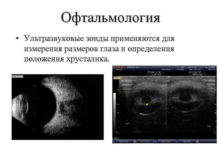Офтальмология • Ультразвуковые зонды применяются для измерения размеров глаза и определения положения хрусталика. 