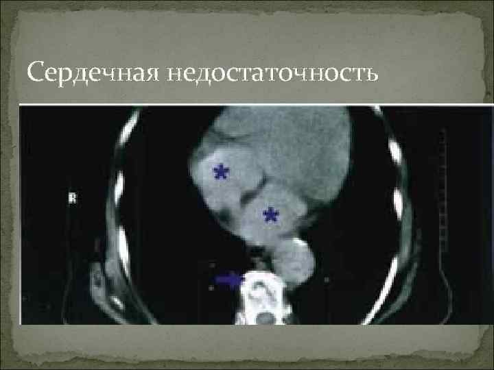 Сердечная недостаточность 