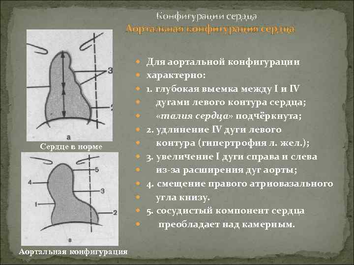 Аортальная конфигурация сердца схема