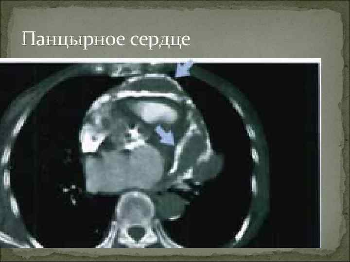 Панцырное сердце 