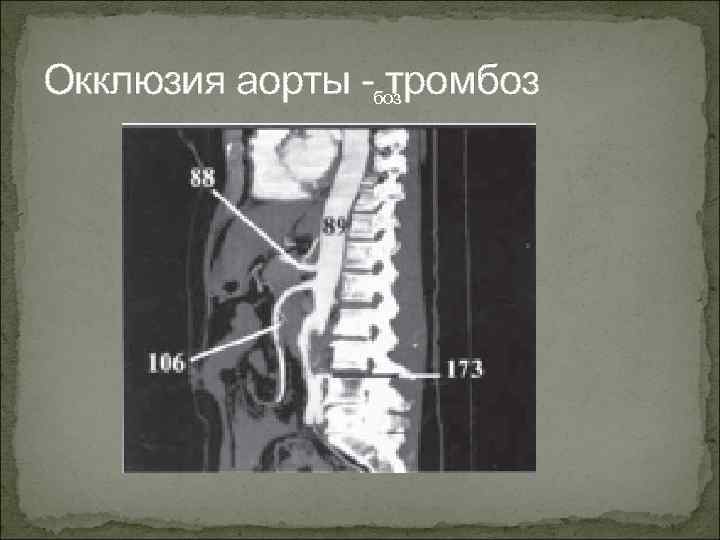 Окклюзия аорты -боз тромбоз 
