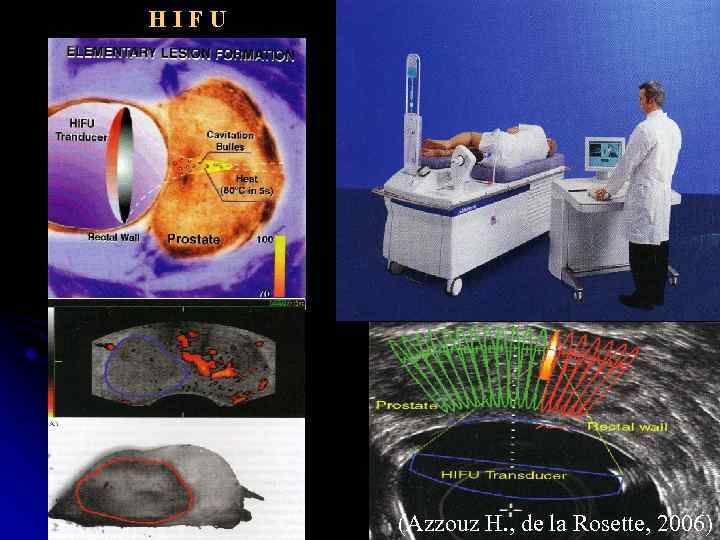 HIFU (Azzouz H. , de la Rosette, 2006) 