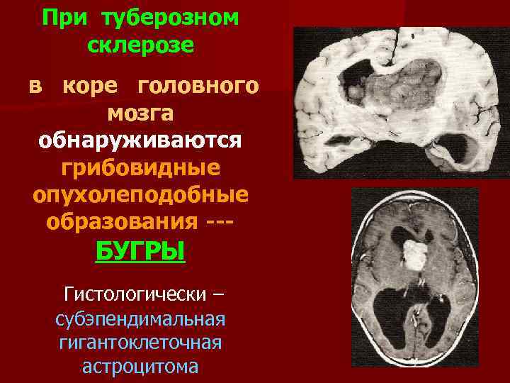 При туберозном склерозе в коре головного мозга обнаруживаются грибовидные опухолеподобные образования --- БУГРЫ Гистологически