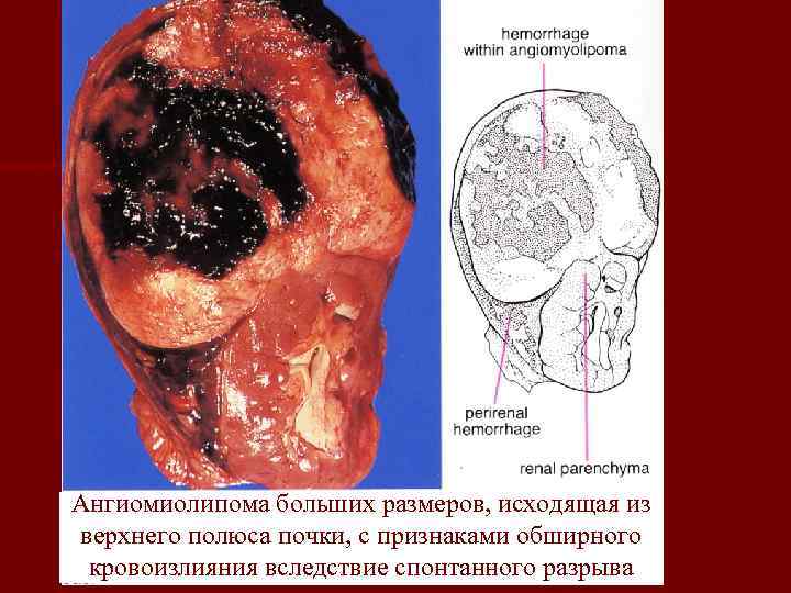 Ангиомиолипома больших размеров, исходящая из верхнего полюса почки, с признаками обширного кровоизлияния вследствие спонтанного