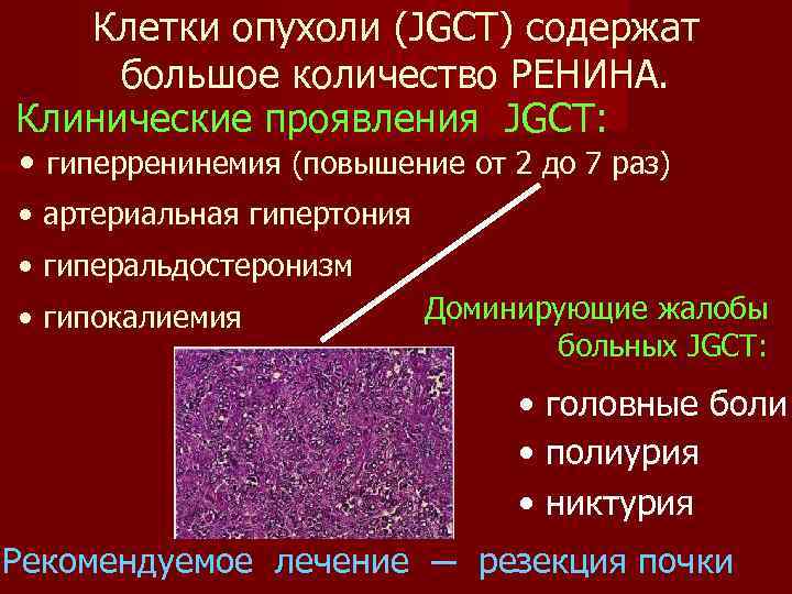 Клетки опухоли (JGCT) содержат большое количество РЕНИНА. Клинические проявления JGCT: • гиперренинемия (повышение от