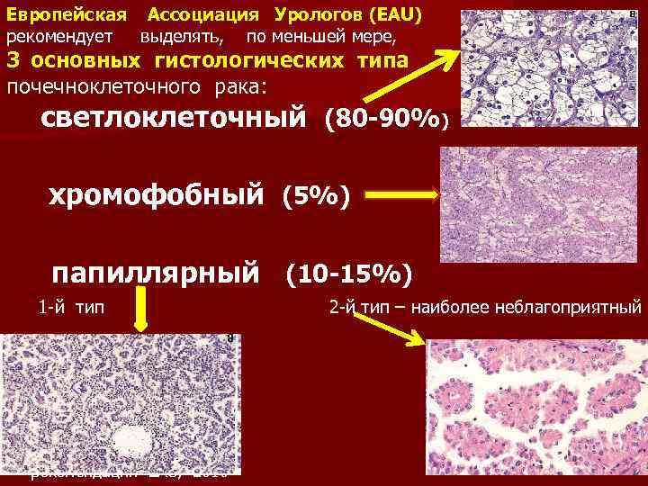 Европейская Ассоциация Урологов (EAU) рекомендует выделять, по меньшей мере, 3 основных гистологических типа почечноклеточного