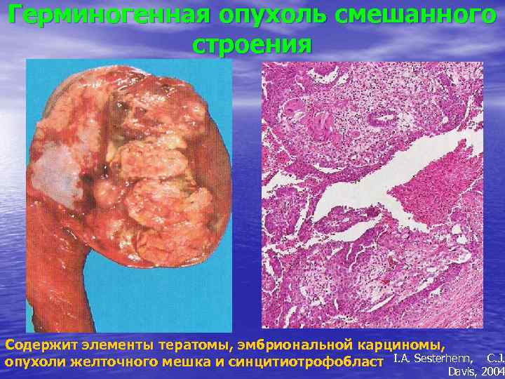 Герминогенная опухоль смешанного строения Содержит элементы тератомы, эмбриональной карциномы, опухоли желточного мешка и синцитиотрофобласт