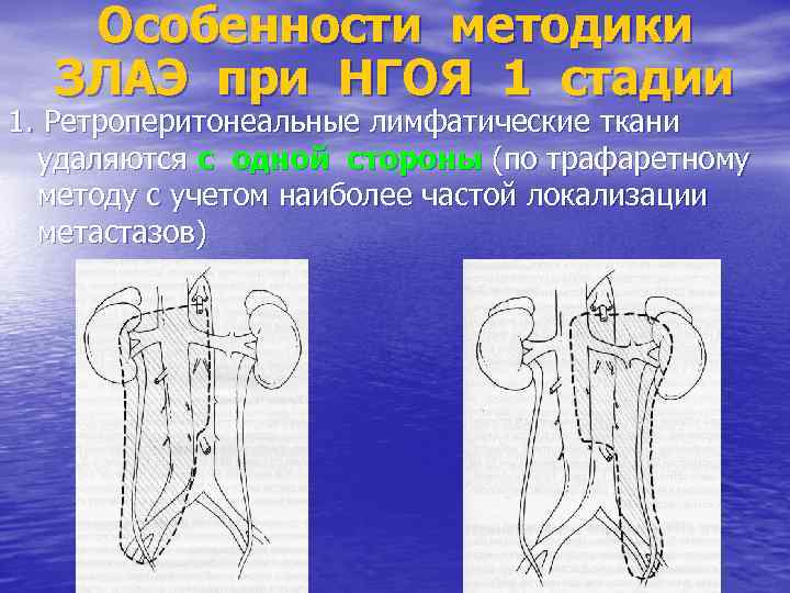 Особенности методики ЗЛАЭ при НГОЯ 1 стадии 1. Ретроперитонеальные лимфатические ткани удаляются с одной