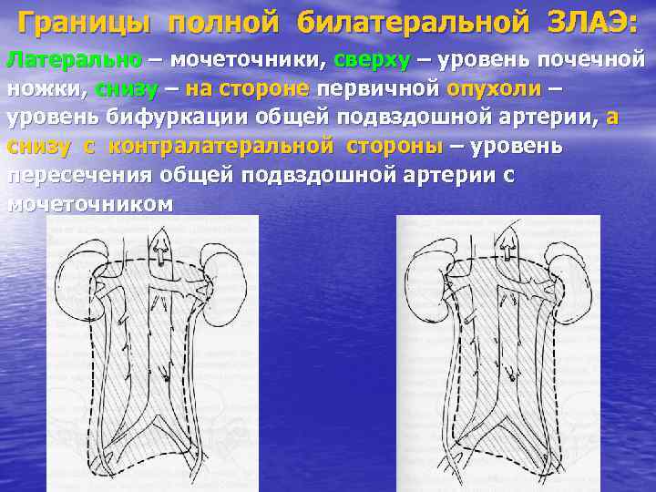 Границы полной билатеральной ЗЛАЭ: Латерально – мочеточники, сверху – уровень почечной ножки, снизу –
