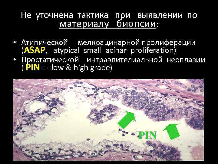 Не уточнена тактика при выявлении по материалу биопсии: • Атипической мелкоацинарной пролиферации (ASAP, atypical
