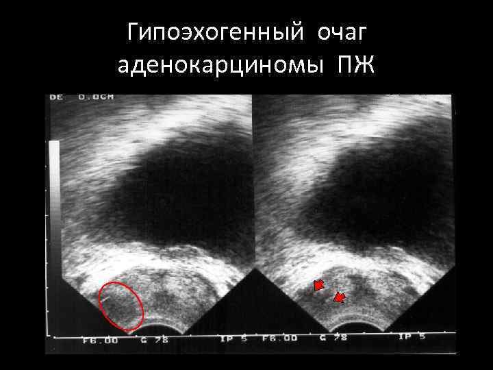 Гипоэхогенный очаг аденокарциномы ПЖ 