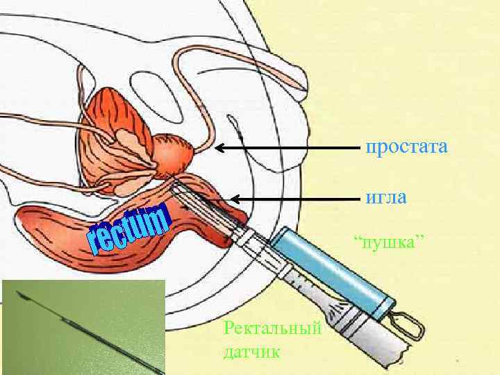 простата игла “пушка” Ректальный датчик 