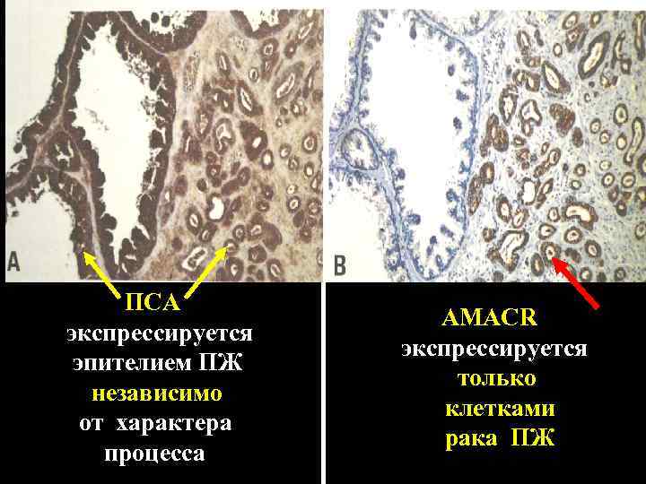 ПСА экспрессируется эпителием ПЖ независимо от характера процесса AMACR экспрессируется только клетками рака ПЖ