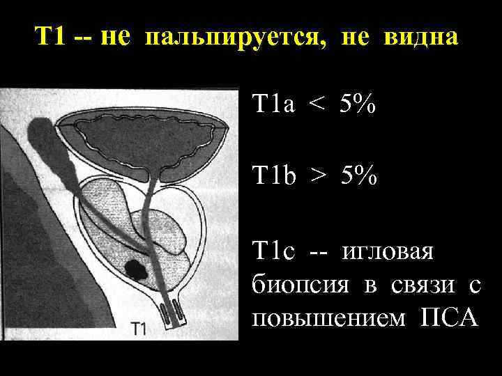 T 1 -- не пальпируется, не видна Т 1 а < 5% Т 1