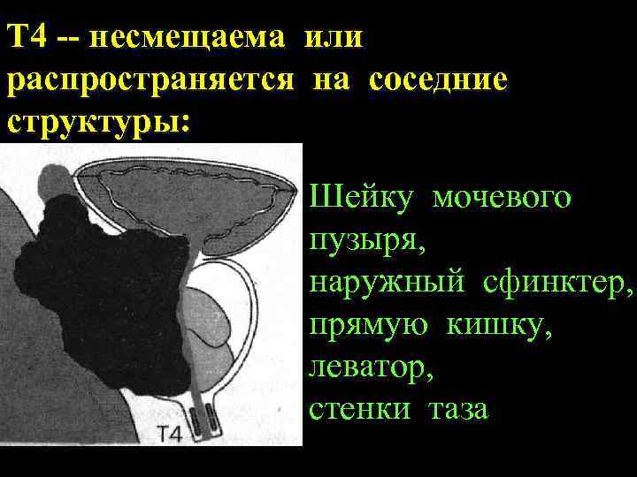 Т 4 -- несмещаема или распространяется на соседние структуры: Шейку мочевого пузыря, наружный сфинктер,