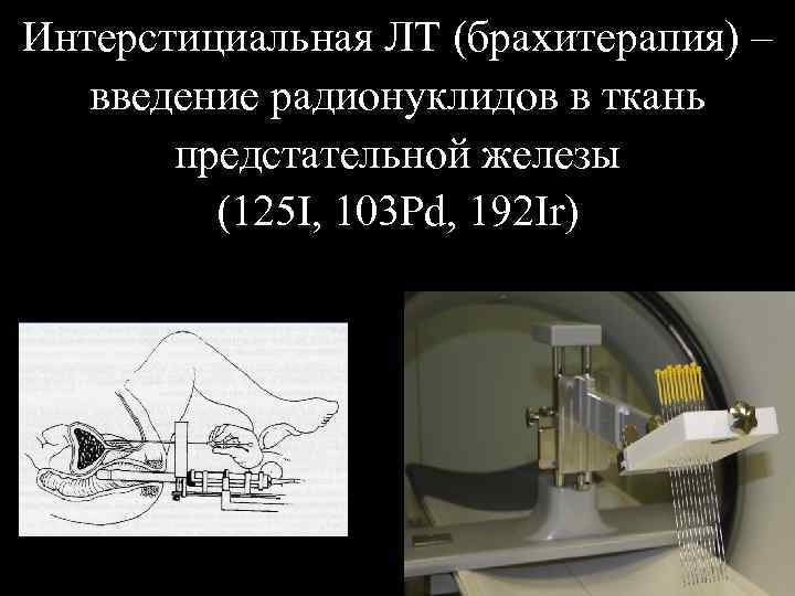 Интерстициальная ЛТ (брахитерапия) – введение радионуклидов в ткань предстательной железы (125 I, 103 Pd,