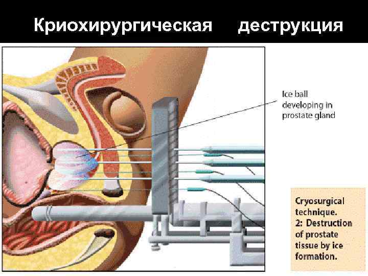 Криохирургическая деструкция 