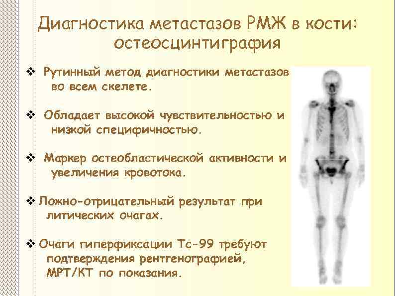 Метастазы в кости срок жизни