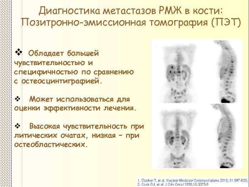 Метастазы костей лечение прогноз. Метастазы в костях симптомы. Сцинтиграфия костей метастазы РМЖ.