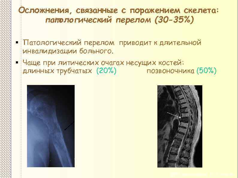 Осложнения, связанные с поражением скелета: патологический перелом (30 -35%) § Патологический перелом приводит к