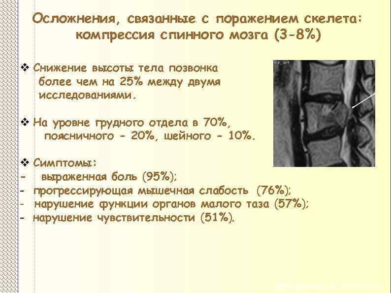 Осложнения, связанные с поражением скелета: компрессия спинного мозга (3 -8%) v Снижение высоты тела