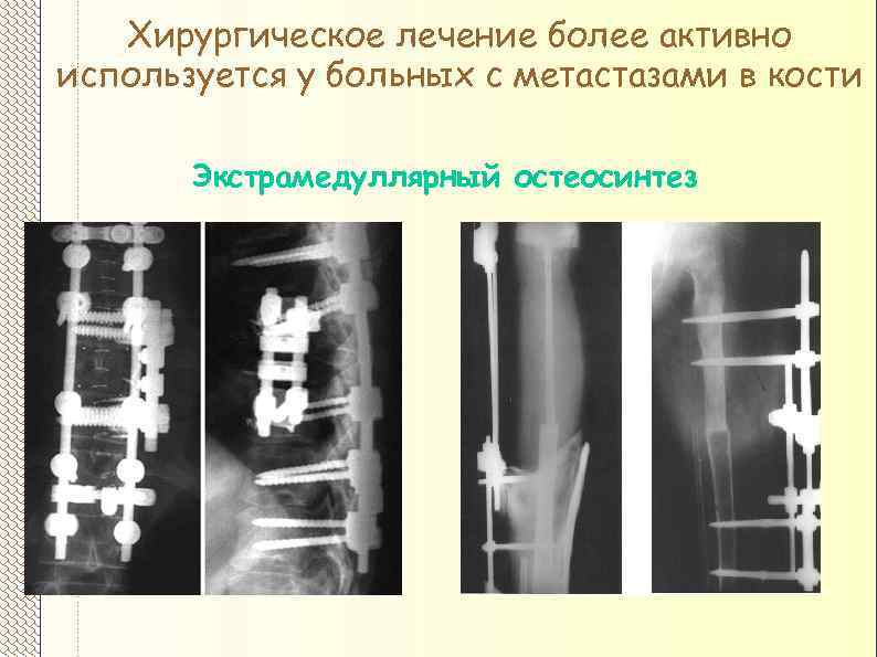 Хирургическое лечение более активно используется у больных с метастазами в кости Экстрамедуллярный остеосинтез 