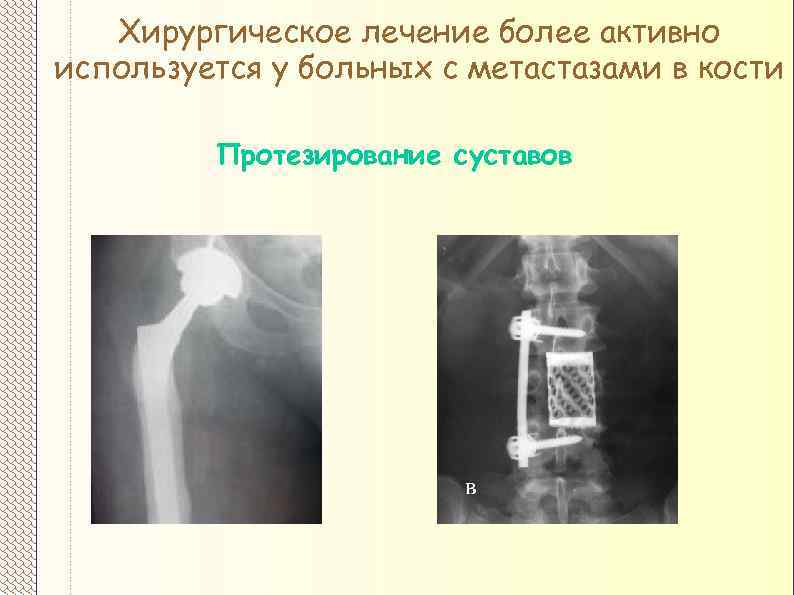 Хирургическое лечение более активно используется у больных с метастазами в кости Протезирование суставов 