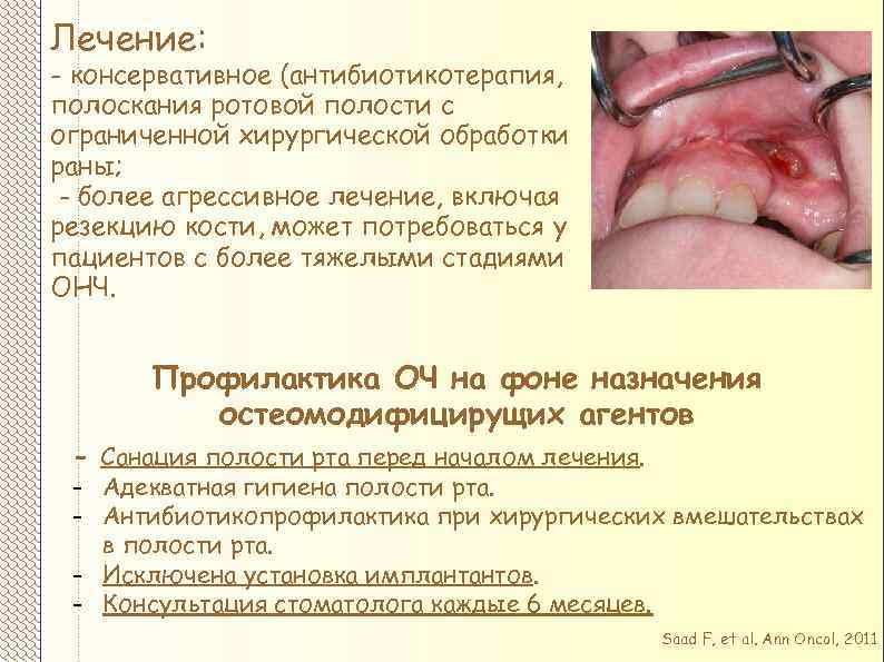 Лечение: - консервативное (антибиотикотерапия, полоскания ротовой полости с ограниченной хирургической обработки раны; - более