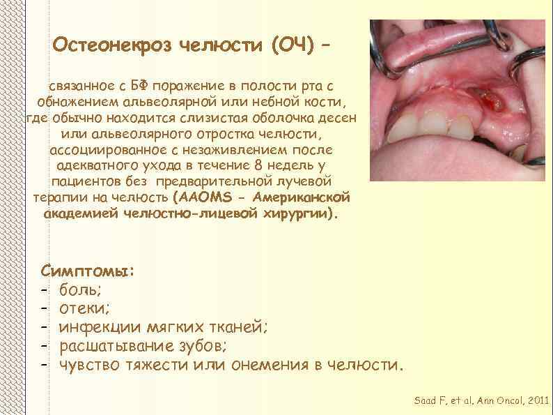 Остеонекроз челюсти (ОЧ) – связанное с БФ поражение в полости рта с обнажением альвеолярной