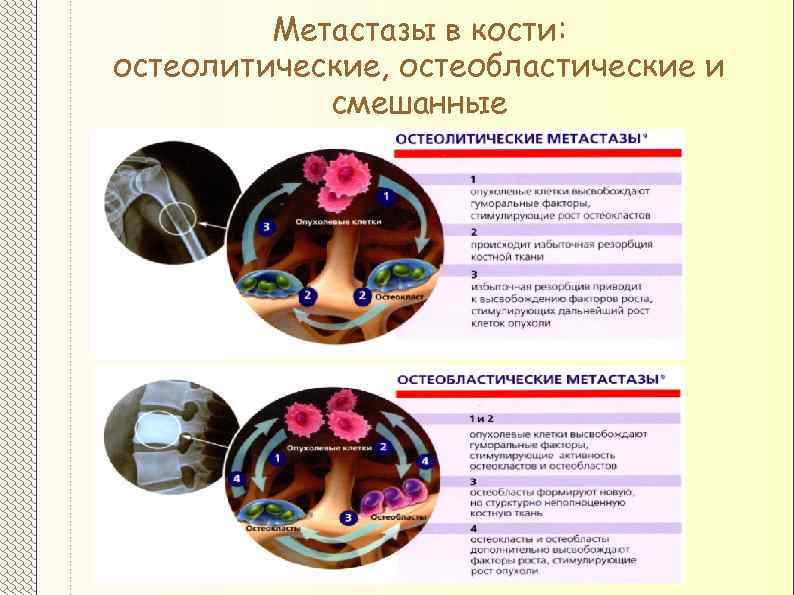 Метастазы в кости: остеолитические, остеобластические и смешанные 
