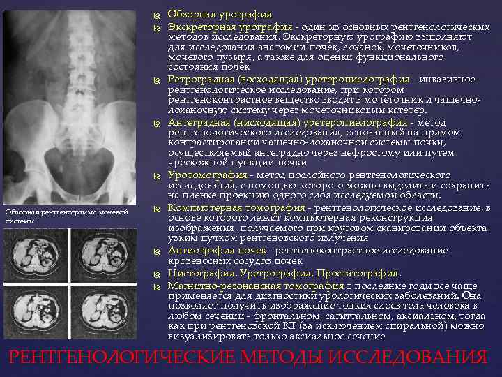  Обзорная рентгенограмма мочевой системы. Обзорная урография Экскреторная урография - один из основных рентгенологических