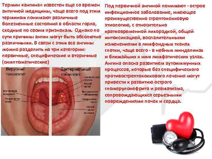 Термин «ангина» известен еще со времен античной медицины, чаще всего под этим термином понимают