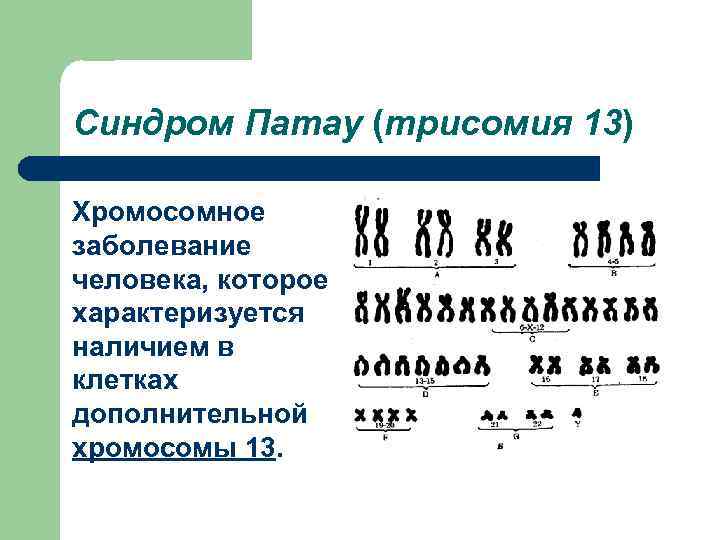 Синдром Патау (трисомия 13) Хромосомное заболевание человека, которое характеризуется наличием в клетках дополнительной хромосомы