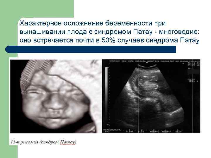 Характерное осложнение беременности при вынашивании плода с синдромом Патау - многоводие: оно встречается почти