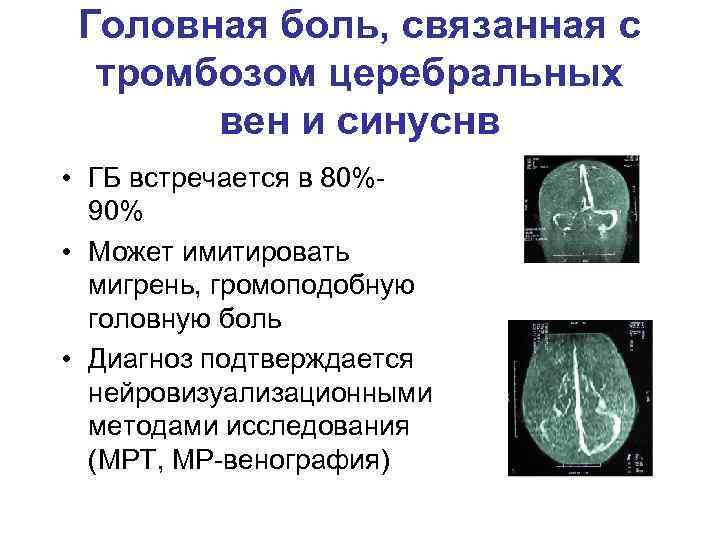 Головная боль, связанная с тромбозом церебральных вен и синуснв • ГБ встречается в 80%90%
