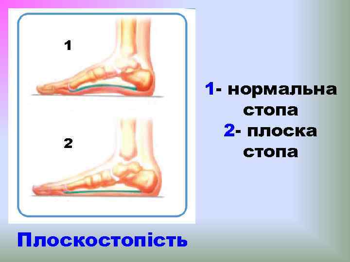 1 2 Плоскостопість 1 - нормальна стопа 2 - плоска стопа 