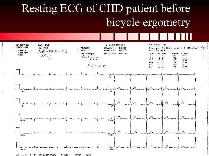 Resting ECG of CHD patient before bicycle ergometry 