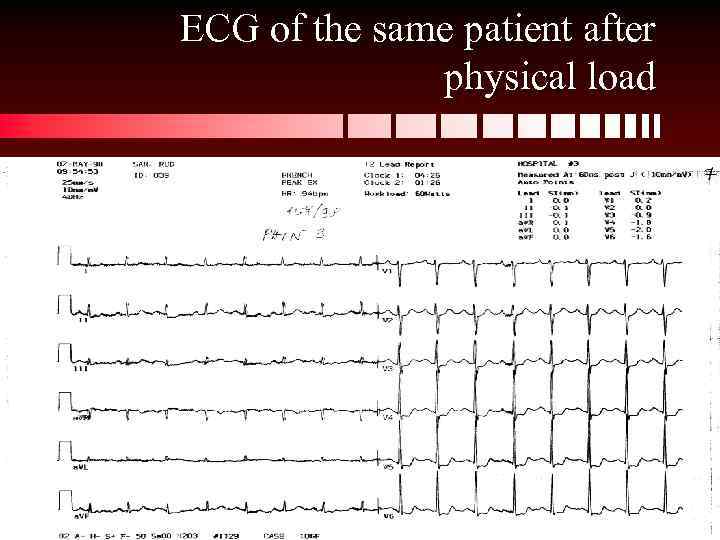 ECG of the same patient after physical load 