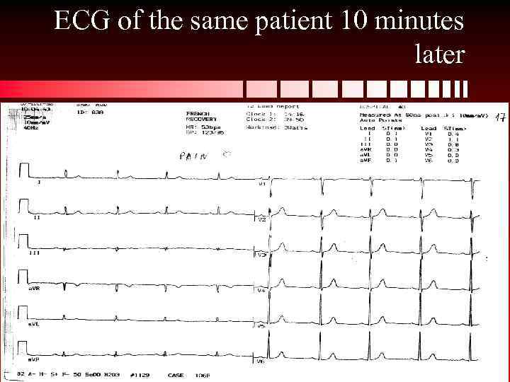 ECG of the same patient 10 minutes later 