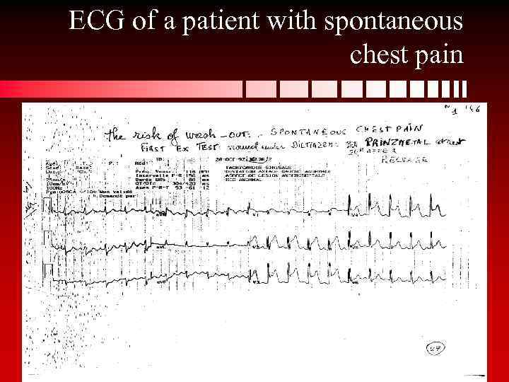 ECG of a patient with spontaneous chest pain 