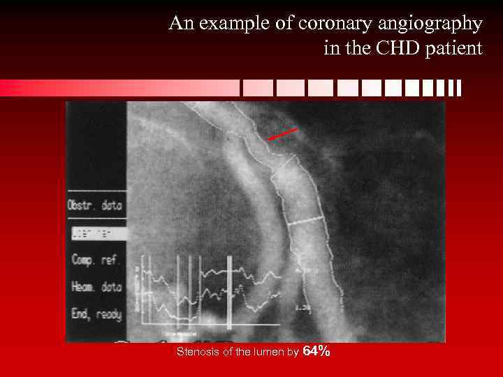 An example of coronary angiography in the CHD patient Stenosis of the lumen by