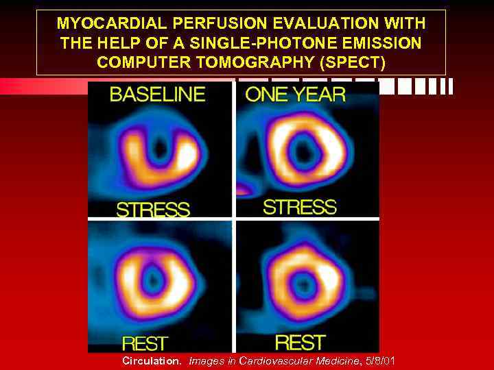 MYOCARDIAL PERFUSION EVALUATION WITH THE HELP OF A SINGLE-PHOTONE EMISSION COMPUTER TOMOGRAPHY (SPECT) Circulation.