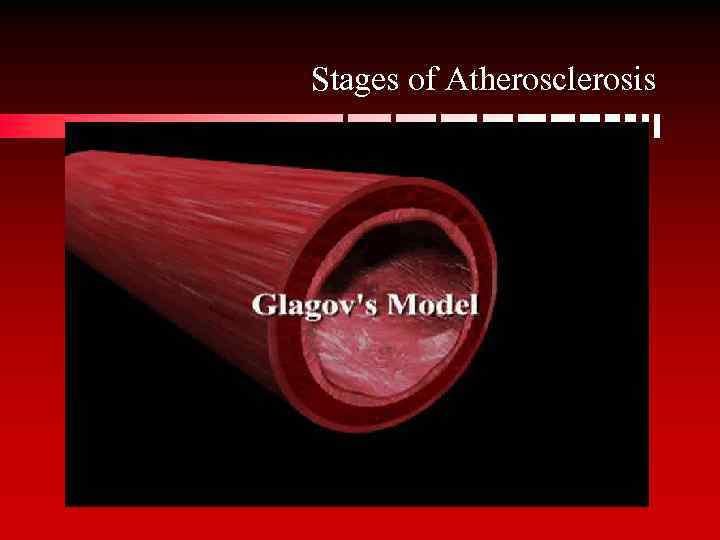 Stages of Atherosclerosis 